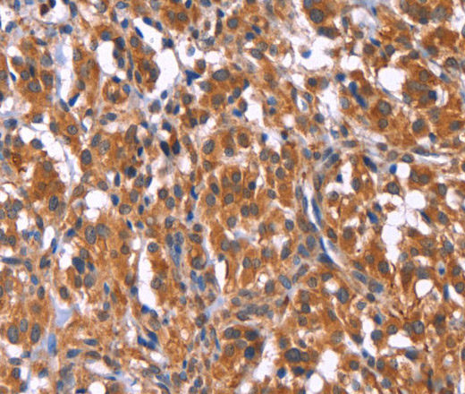 Immunohistochemistry of paraffin-embedded Human thyroid cancer tissue using TDP2 Polyclonal Antibody at dilution 1:40