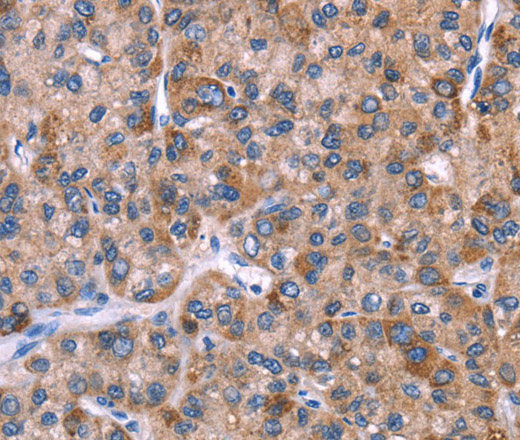 Immunohistochemistry of paraffin-embedded Human liver cancer tissue using EVC2 Polyclonal Antibody at dilution 1:40