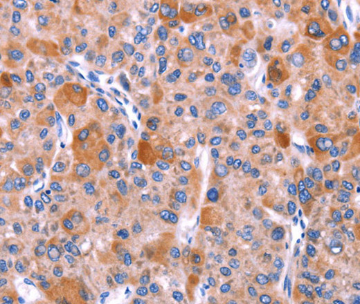 Immunohistochemistry of paraffin-embedded Human liver cancer tissue using GCG Polyclonal Antibody  at dilution 1:40