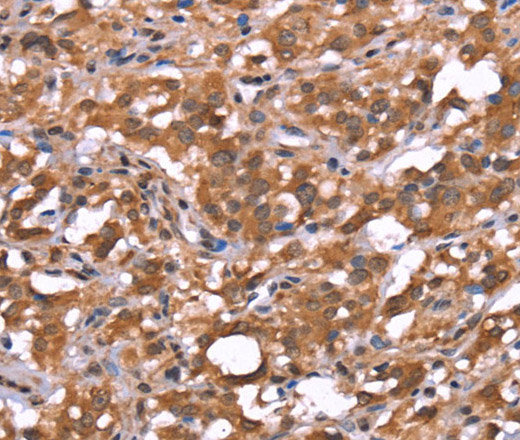 Immunohistochemistry of paraffin-embedded Human thyroid cancer tissue using AMER1 Polyclonal Antibody at dilution 1:40