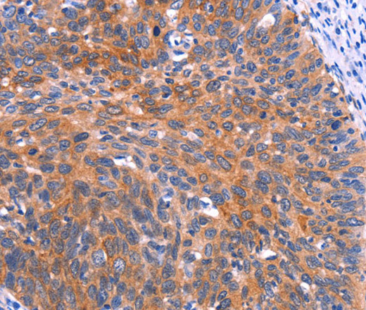 Immunohistochemistry of paraffin-embedded Human cervical cancer tissue using PTPN13 Polyclonal Antibody at dilution 1:30