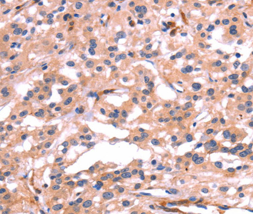 Immunohistochemistry of paraffin-embedded Human thyroid cancer tissue using PTPN13 Polyclonal Antibody at dilution 1:30