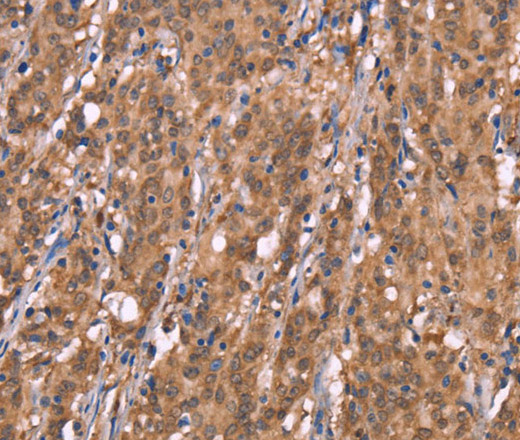 Immunohistochemistry of paraffin-embedded Human gasrtic cancer tissue using FBXO31 Polyclonal Antibody at dilution 1:40