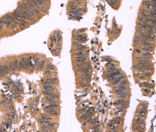 Immunohistochemistry of paraffin-embedded Human colon cancer tissue using FBXO31 Polyclonal Antibody at dilution 1:40