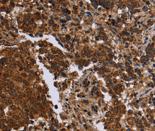 Immunohistochemistry of paraffin-embedded Human liver cancer tissue using FMN2 Polyclonal Antibody at dilution 1:30