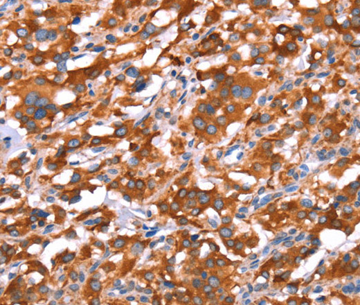 Immunohistochemistry of paraffin-embedded Human thyroid cancer tissue using GAS8 Polyclonal Antibody at dilution 1:40