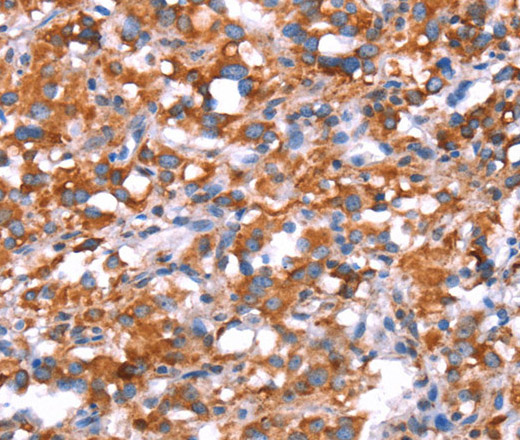 Immunohistochemistry of paraffin-embedded Human thyroid cancer using GH1 Polyclonal Antibody at dilution of 1:40