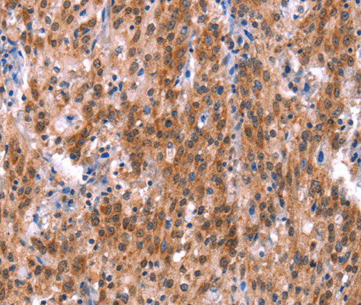 Immunohistochemistry of paraffin-embedded Human gastric cancer using GH1 Polyclonal Antibody at dilution of 1:40