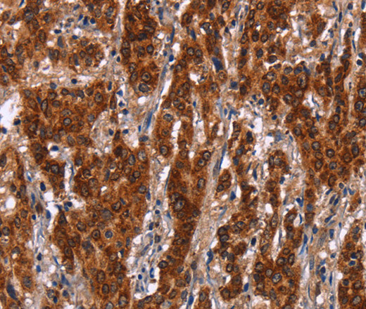 Immunohistochemistry of paraffin-embedded Human gastric cancer tissue using GCKR Polyclonal Antibody at dilution 1:50