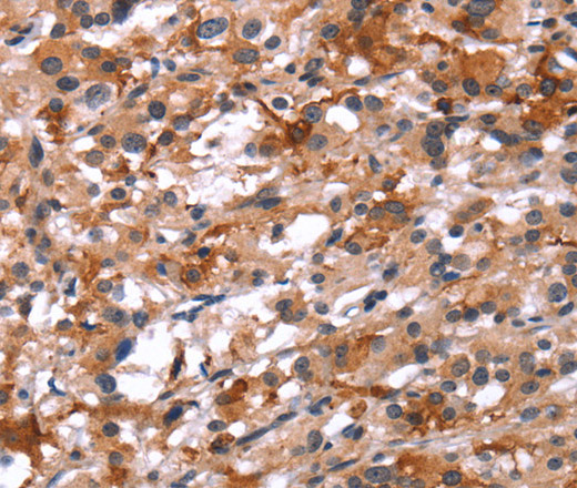 Immunohistochemistry of paraffin-embedded Human thyroid cancer using Glucagon Receptor Polyclonal Antibody at dilution of 1:40