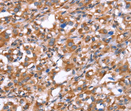 Immunohistochemistry of paraffin-embedded Human thyroid cancer tissue using GPC6 Polyclonal Antibody at dilution 1:40