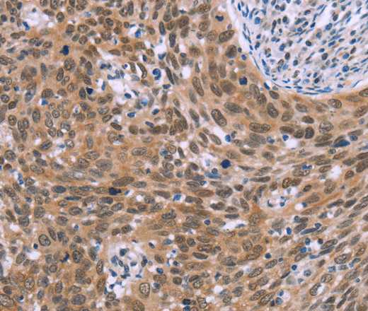 Immunohistochemistry of paraffin-embedded Human cervical cancer tissue using GLYR1 Polyclonal Antibody at dilution 1:30