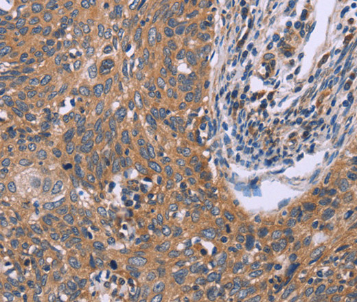 Immunohistochemistry of paraffin-embedded Human cervical cancer tissue using IL3RB Polyclonal Antibody at dilution 1:40