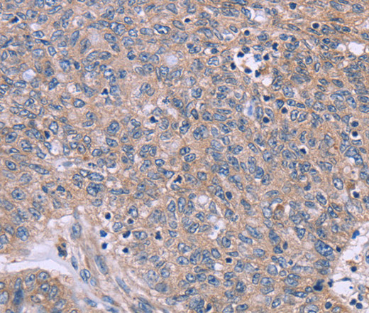 Immunohistochemistry of paraffin-embedded Human ovarian cancer tissue using IL3RB Polyclonal Antibody at dilution 1:40