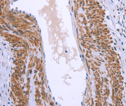 Immunohistochemistry of paraffin-embedded Human cervical cancer tissue using GNPAT Polyclonal Antibody at dilution 1:40