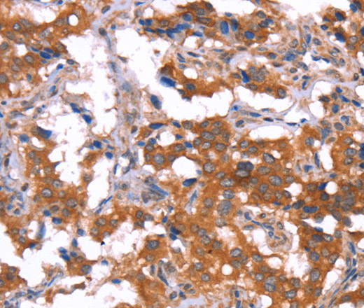 Immunohistochemistry of paraffin-embedded Human thyroid cancer tissue using HCAR2 Polyclonal Antibody at dilution 1:40