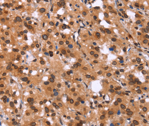 Immunohistochemistry of paraffin-embedded Human thyroid cancer tissue using GPR124 Polyclonal Antibody at dilution 1:40