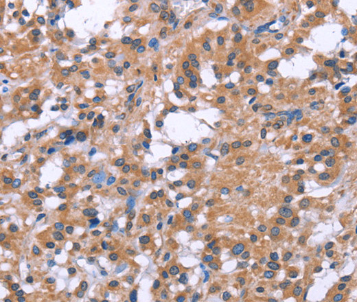 Immunohistochemistry of paraffin-embedded Human thyroid cancer tissue using GPR172B Polyclonal Antibody at dilution 1:40