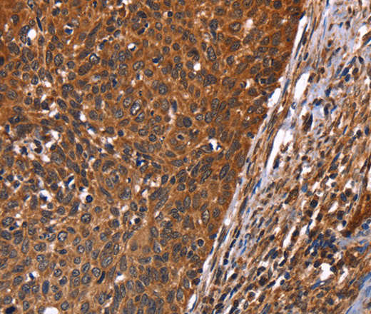 Immunohistochemistry of paraffin-embedded Human cervical cancer tissue using GUK1 Polyclonal Antibody at dilution 1:40