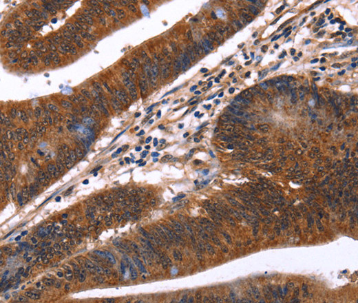 Immunohistochemistry of paraffin-embedded Human colon cancer tissue using GUK1 Polyclonal Antibody at dilution 1:40