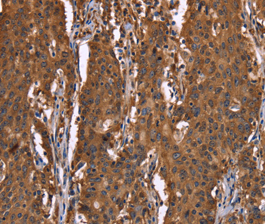 Immunohistochemistry of paraffin-embedded Human gastic cancer using HINT1 Polyclonal Antibody at dilution of 1:30