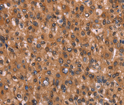 Immunohistochemistry of paraffin-embedded Human liver cancer using HINT1 Polyclonal Antibody at dilution of 1:30