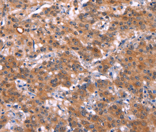 Immunohistochemistry of paraffin-embedded Human gastic cancer using HMGCS1 Polyclonal Antibody at dilution of 1:40