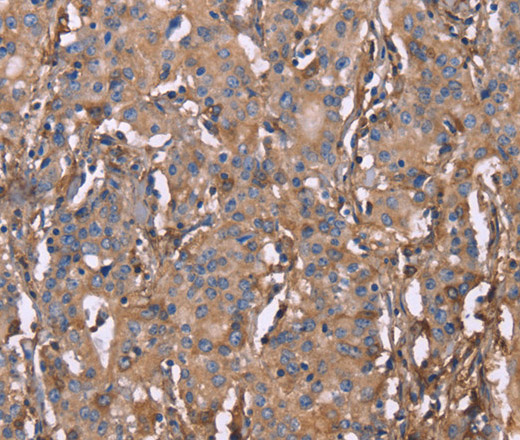 Immunohistochemistry of paraffin-embedded Human gastric cancer tissue using HP Polyclonal Antibody at dilution 1:50