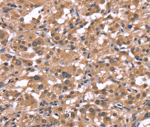 Immunohistochemistry of paraffin-embedded Human thyroid cancer using Histamine H1 Receptor Polyclonal Antibody at dilution of 1:40