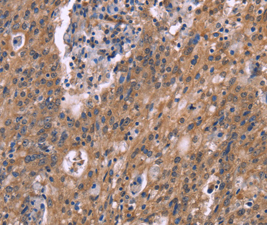 Immunohistochemistry of paraffin-embedded Human liver cancer tissue using HSD11B2 Polyclonal Antibody at dilution 1:35