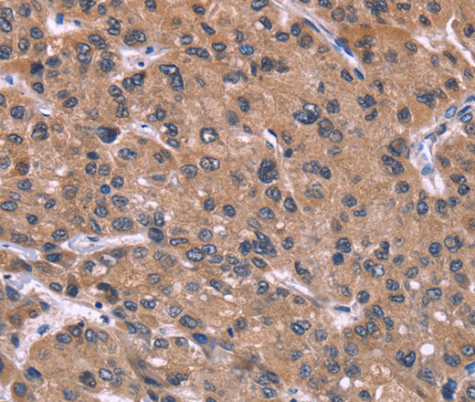 Immunohistochemistry of paraffin-embedded Human prostate cancer tissue using HSD11B2 Polyclonal Antibody at dilution 1:35