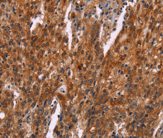 Immunohistochemistry of paraffin-embedded Human gastric cancer tissue using HSPB6 Polyclonal Antibody at dilution 1:30