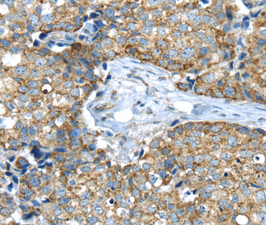 Immunohistochemistry of paraffin-embedded Human gasrtic cancer tissue using IFNA2 Polyclonal Antibody at dilution 1:40