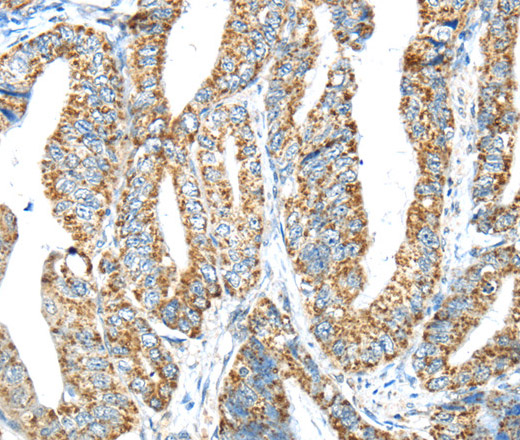 Immunohistochemistry of paraffin-embedded Human colon cancer tissue using IFNA2 Polyclonal Antibody at dilution 1:40