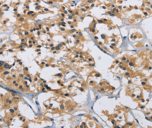 Immunohistochemistry of paraffin-embedded Human thyroid cancer tissue using IL12RB2 Polyclonal Antibody at dilution 1:40