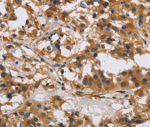 Immunohistochemistry of paraffin-embedded Human thyroid cancer tissue using IL17RB Polyclonal Antibody at dilution 1:40