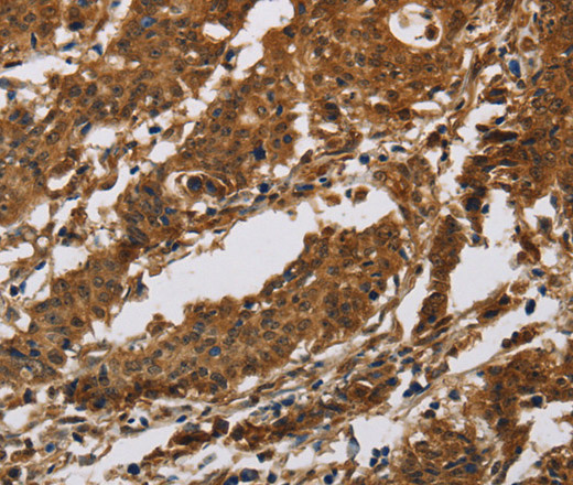 Immunohistochemistry of paraffin-embedded Human gastric cancer tissue using IL17RB Polyclonal Antibody at dilution 1:40