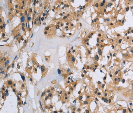 Immunohistochemistry of paraffin-embedded Human thyroid cancer using IL5RA Polyclonal Antibody at dilution of 1:40