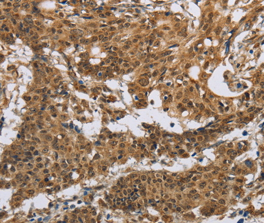 Immunohistochemistry of paraffin-embedded Human gastric cancer using IL5RA Polyclonal Antibody at dilution of 1:40