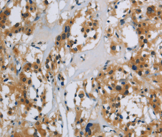 Immunohistochemistry of paraffin-embedded Human thyroid cancer using SYN1 Polyclonal Antibody at dilution of 1:40