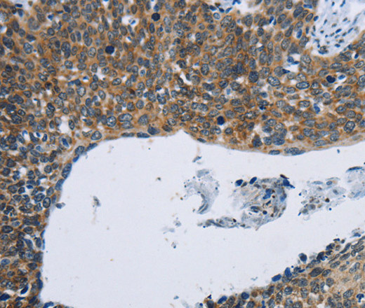 Immunohistochemistry of paraffin-embedded Human cervical cancer tissue using KPNB1 Polyclonal Antibody at dilution 1:40