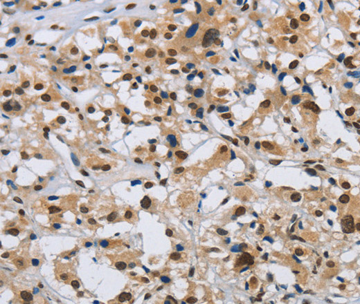 Immunohistochemistry of paraffin-embedded Human thyroid cancer tissue using KPNB1 Polyclonal Antibody at dilution 1:40