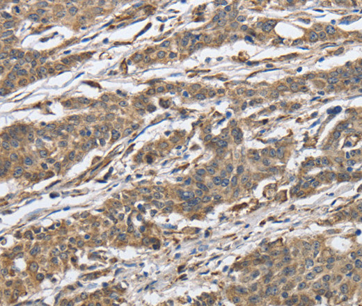 Immunohistochemistry of paraffin-embedded Human gastic cancer using IPO7 Polyclonal Antibody at dilution of 1:40