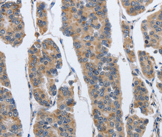 Immunohistochemistry of paraffin-embedded Human breast cancer using IPO7 Polyclonal Antibody at dilution of 1:40