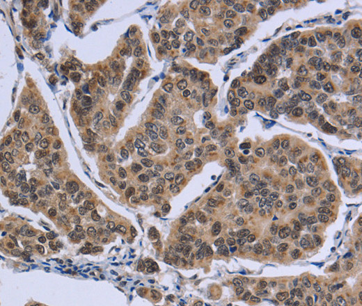 Immunohistochemistry of paraffin-embedded Human breast cancer tissue using IPO8 Polyclonal Antibody at dilution 1:50