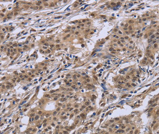 Immunohistochemistry of paraffin-embedded Human gastric cancer tissue using IPO8 Polyclonal Antibody at dilution 1:50