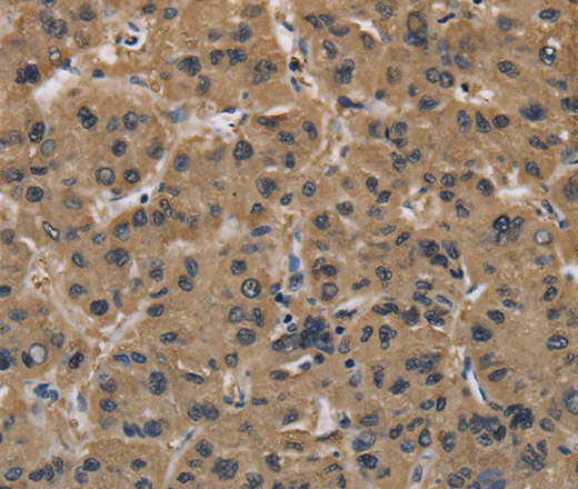 Immunohistochemistry of paraffin-embedded Human liver cancer using FABP2 Polyclonal Antibody at dilution of 1:40