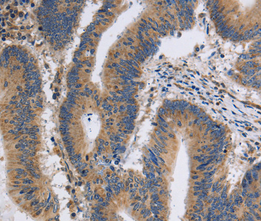 Immunohistochemistry of paraffin-embedded Human colon cancer tissue using ITPR1 Polyclonal Antibody at dilution 1:40