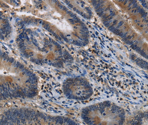 Immunohistochemistry of paraffin-embedded Human colon cancer tissue using ITPR2 Polyclonal Antibody at dilution 1:40