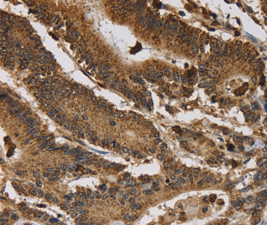 Immunohistochemistry of paraffin-embedded Human colon cancer tissue using ITPR3 Polyclonal Antibody at dilution 1:40